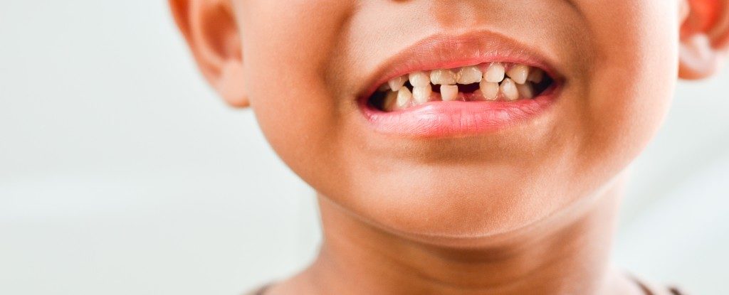 tooth decay of a child